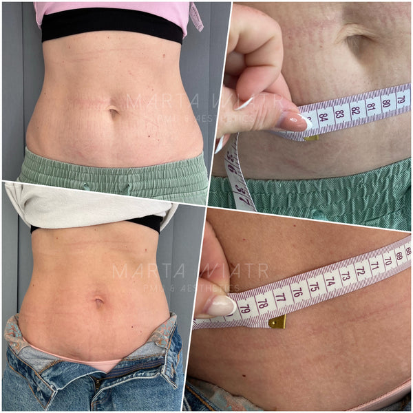 FAT DISSOLVING INJECTIONS